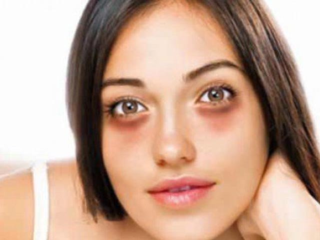 目の下のクマ、そのクマは病気からくるものかも