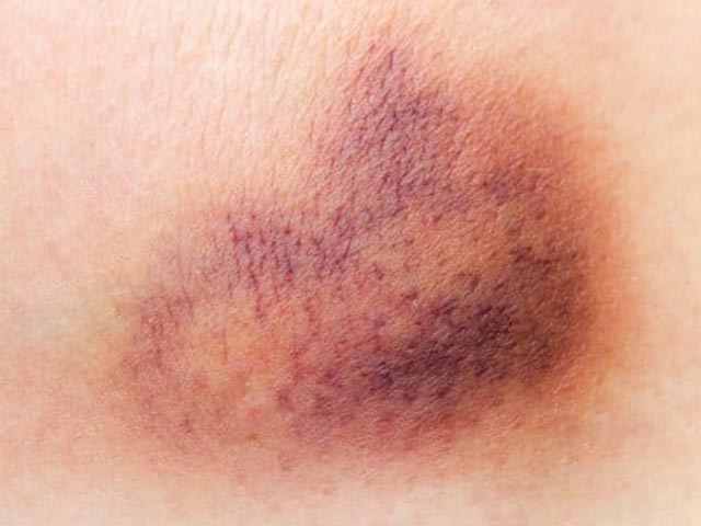 体にアザが出来やすい人には特徴があった！