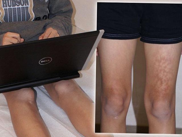 トースト肌症候群とは？｜八尾市整骨院